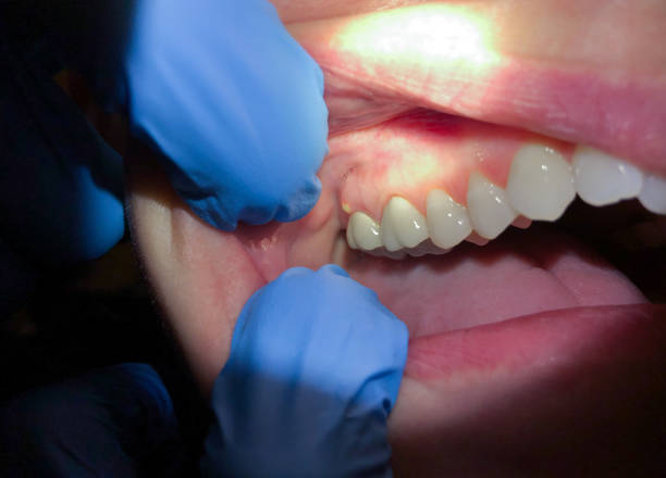 Best Cracked Tooth Emergency Dentist  in Fort Payne, AL