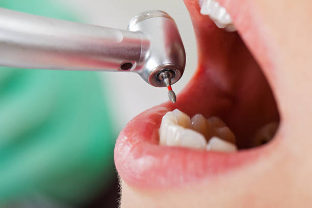 Best Knocked-Out Tooth Emergency  in Fort Payne, AL